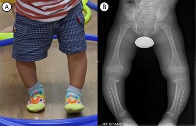 Case Report and Review of Literature: Autosomal Recessive Hypophosphatemic Rickets Type 2 Caused by a Pathogenic Variant in ENPP1 Gene